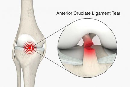 Anterior Cruciate Ligament Tear